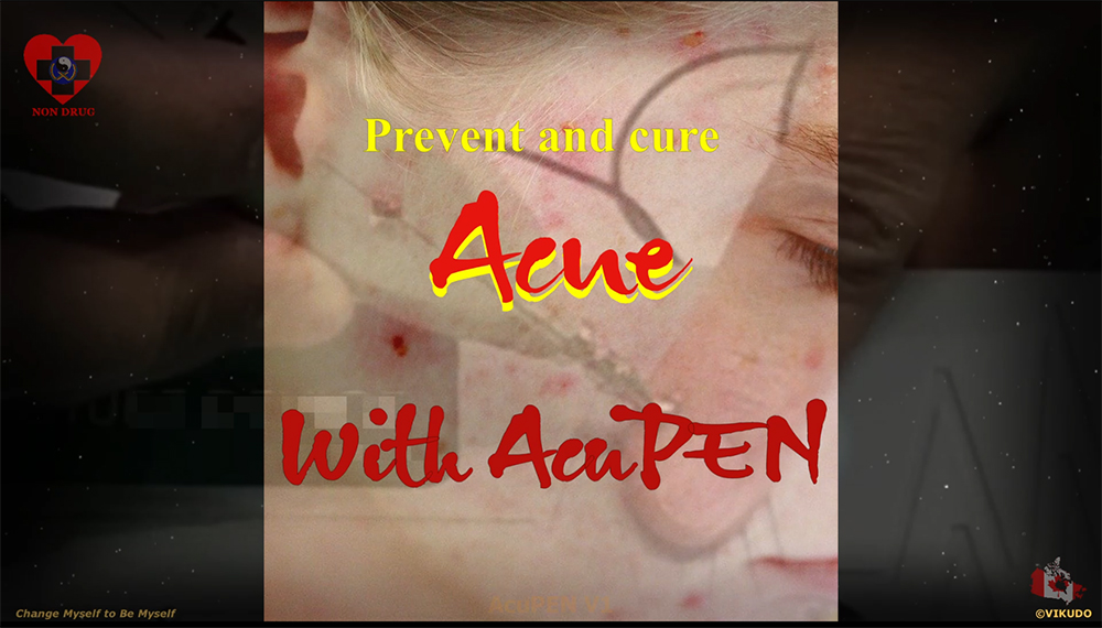 Acupen V1 _ Prevent and Treat ACNE with AcuPEN _ Electro Acupuncture Pen